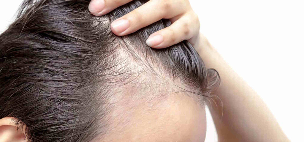 Сильно выпадают волосы на голове лечение. Алопеция у женщин фото начальная стадия. Алопеция на фоне себореи. Морщины выпадение волос. Выпадение волос из за себореи.