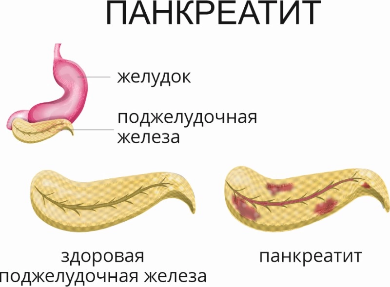 Панкреатит группа. Панкреатит у беременных.